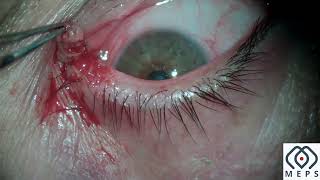 Eyelid Nevus Excision with RF [upl. by Patt]