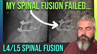 L4L5 Spinal Fusion Failure 2 Weeks After SurgeryNow WHAT [upl. by Nireves596]