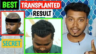 Getting BEST RESULT IN HAIR TRANSPLANT FOLLOW THESE TIPS [upl. by Nica]