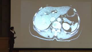 Surgical anatomy of perihilar cholangiocarcinoma [upl. by Earvin]