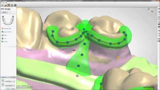 Removable Partial Dentures Design with 3Shape  Maptec KSA [upl. by Latnahc330]