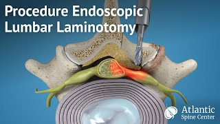 Procedure Endoscopic Lumbar Laminotomy [upl. by Braden]