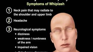 Whiplash Injury Animation  Everything You Need to Know  Dr Nabil Ebraheim MD [upl. by Gerard]