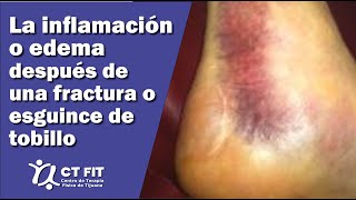 Inflamación de tobillo después de una fractura o esguince  Centro de Terapia Física de Tijuana [upl. by Amlez]