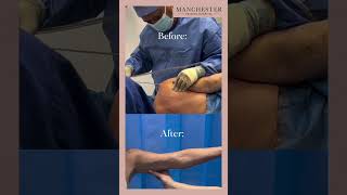 Debra’s Arm Vaser Liposuction Story 7Week Updates  Transformation to Slim PainFree Arms [upl. by Hultgren]