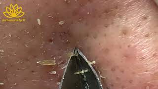 Best Satisfying Nose Plucking Blackheads Whiteheads Removal  Acne Treatment 54 [upl. by Lezley]