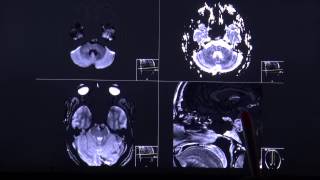 Chordoma  aggressively growing tumor in CT and MRI sequence english [upl. by Mela17]