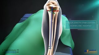 Precice Tibia Lengthening Surgical Animation [upl. by Rora]