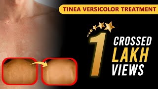 Tinea Versicolor Treatment  टीनेया वेर्सिकलर  કરોળિયા  Dr Jagdish Sakhiya  in Hindi [upl. by Myrtia361]