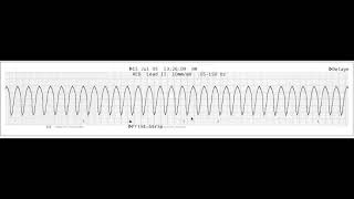 Shockable rhythms [upl. by Ramiah]