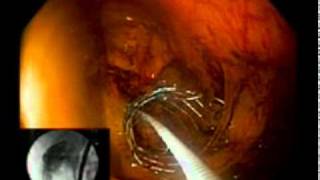 Large Bowel Obstruction Colonic Stent [upl. by Damien225]