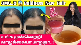 OMG😱 Baldness Hair Growth Treatment  frontal baldness hair regrowth in tamil  Jegathees meena [upl. by Otrebogir]