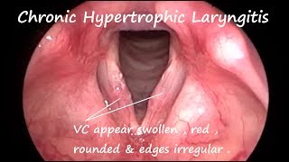 Laryngology  Chronic Hypertrophic Laryngitis [upl. by Ursel630]