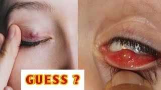 Stye or chalazion  explained indetail eyecareoptom eyelid infection lidproblems [upl. by Llerrit]