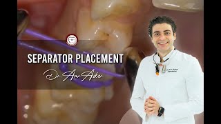 separator placement in orthodontics for HYRAX by Dr Amr Asker [upl. by Yornoc]