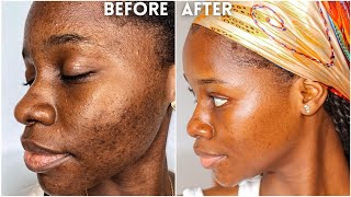 How I cleared my 8 years ACNE amp HYPERPIGMENTATION  How I got rid of textured skin amp got GLASS SKIN [upl. by Enitsirc914]