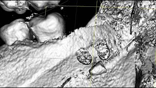 Lingual displacement of a mandibular third molar root fragment – extraction [upl. by Llezom]