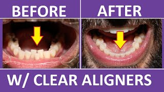 Invisalign Braces Before and After Overbite Crowding Teeth Cost Pain Tips 3M Clear Aligners [upl. by Nniuq]