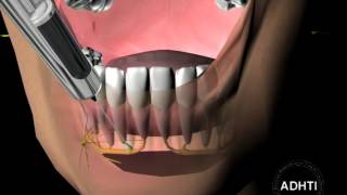 инфильтрационная анестезия на нижней челюстиinfiltration anesthesia in the mandible [upl. by Gonick]