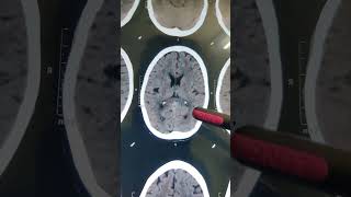 INTRACRANIAL CALCIFICATION doctor hospital  shorts video [upl. by Maureen]