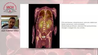 Elder Man with Perinephric Fibrosis [upl. by Carolus]