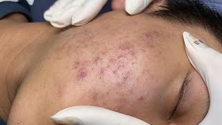 ACNE TREATMENT VU QUYNH MI Acne On Teens Chin 2024 [upl. by Kcirdled323]