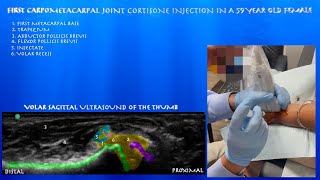 Ultrasound Guided Carpometacarpal Joint Injection in a 59 Year Old Female by probeultrasound [upl. by Ecirtam446]