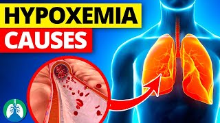 THIS is Causing Your Low Oxygen Levels  Hypoxemia Causes [upl. by Ominorej]