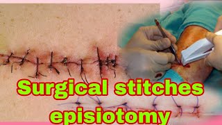 Surgical stitch Technique  Types  Episiotomy procedure and Artificial Stitchessurgery [upl. by Frodin]