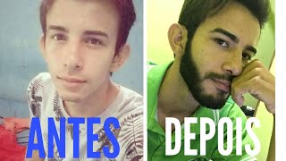 Antes e depois minoxidil na barba Minoxidil beard before and after [upl. by Anaoy138]