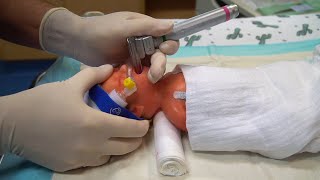 Hobart Method of Minimally Invasive Surfactant Therapy Administration in a Resuscitation Manikin [upl. by Aivat]