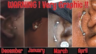 Surface Tragus Piercing GONE WRONG  Viewers Discretion Advised [upl. by Nikolas]