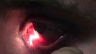 Ophthalmic Skills Video  Basics in Slit Lamp Examination [upl. by Morten695]