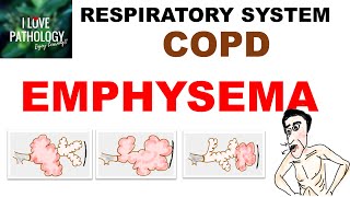 Chronic Obstructive Pulmonary Disease Part 1 Emphysema Pathology [upl. by Adah]