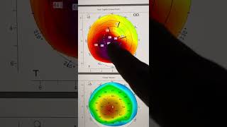 Planning an AthensProtocolCXLtopoguided surface ablation case for keratoconus Kanellopoulos MD [upl. by Eniamzaj479]