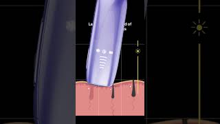 Why Choose IPL Hair Removal The Benefits of LightBased Technology Rxmoore IPL hair removal [upl. by Ehcadroj]