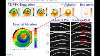 LoVC Course on Therapeutic Corneal Refractive Surgery Part 6 of 6 Protocol for TEPTK [upl. by Attenal]