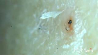 Scabs with ingrown hairs plucked out and some other gross removals [upl. by Yenaj514]