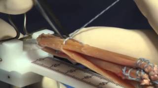 Hamstring Autograft Technique for ACL Reconstruction Surgery [upl. by Selia]