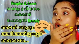 😳In ₹0  Remove Pimples amp Acnes Completely in just 3 days😱 [upl. by Elleraj]