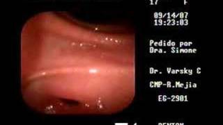 Endoscopia Digestiva Lizy [upl. by Adnuahsor]