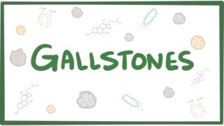 Gallstones cholelithiasis [upl. by Harlamert258]