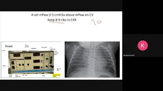 Case management for neonate on HFOV by RT Kholoud [upl. by Doloritas567]