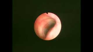 Veterinary Bronchoscopy019Primary Tracheal Collapse9DAY666 [upl. by Anomis]