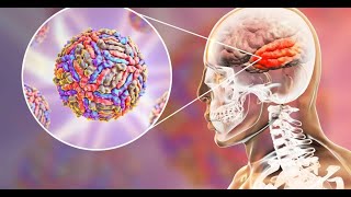 Rare Case of Meningoencephalitis byListeria monocytogenes in a YoungImmunocompetent Adult [upl. by Hurlbut]