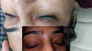 Result 5 Minutes Xanthelasma Removal  without Pain or Bleeding  Kayakalp Laser Clinic [upl. by Enneirdna]