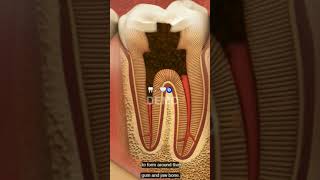 Endodontics please take care of your teeth as soon as decay starts visit your dentist tooth doctor🧿 [upl. by Kappenne710]