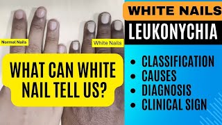 White Nails Leukonychia  Classification Causes Diagnosis  Nail Changes in Systemic Diseases [upl. by Nednarb]