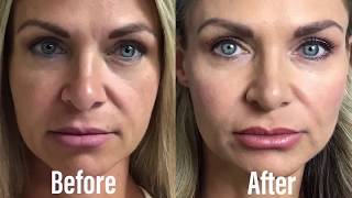 Dermal Filler Cheek Restoration Restylane Defyne [upl. by Hauser]