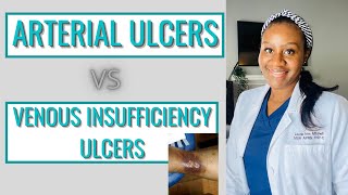 Venous Insufficiency ulcers vs Arterial Insufficiency ulcers  woundcarewednesday  Fromcnatonp [upl. by Estrin]